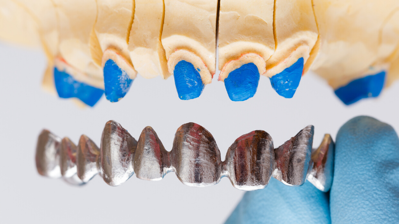 navlake za zube - Dentalharmony
