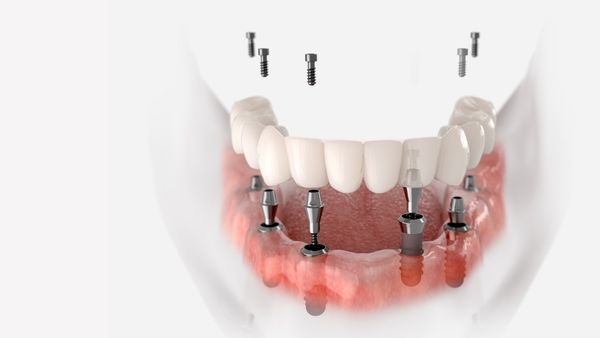 All-on-6 metoda_Dentalharmony