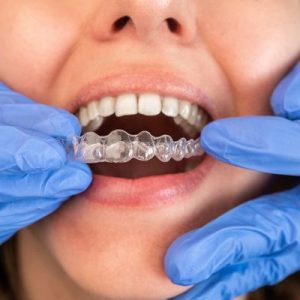 Folije za ispravljanje zuba_Dentalharmony