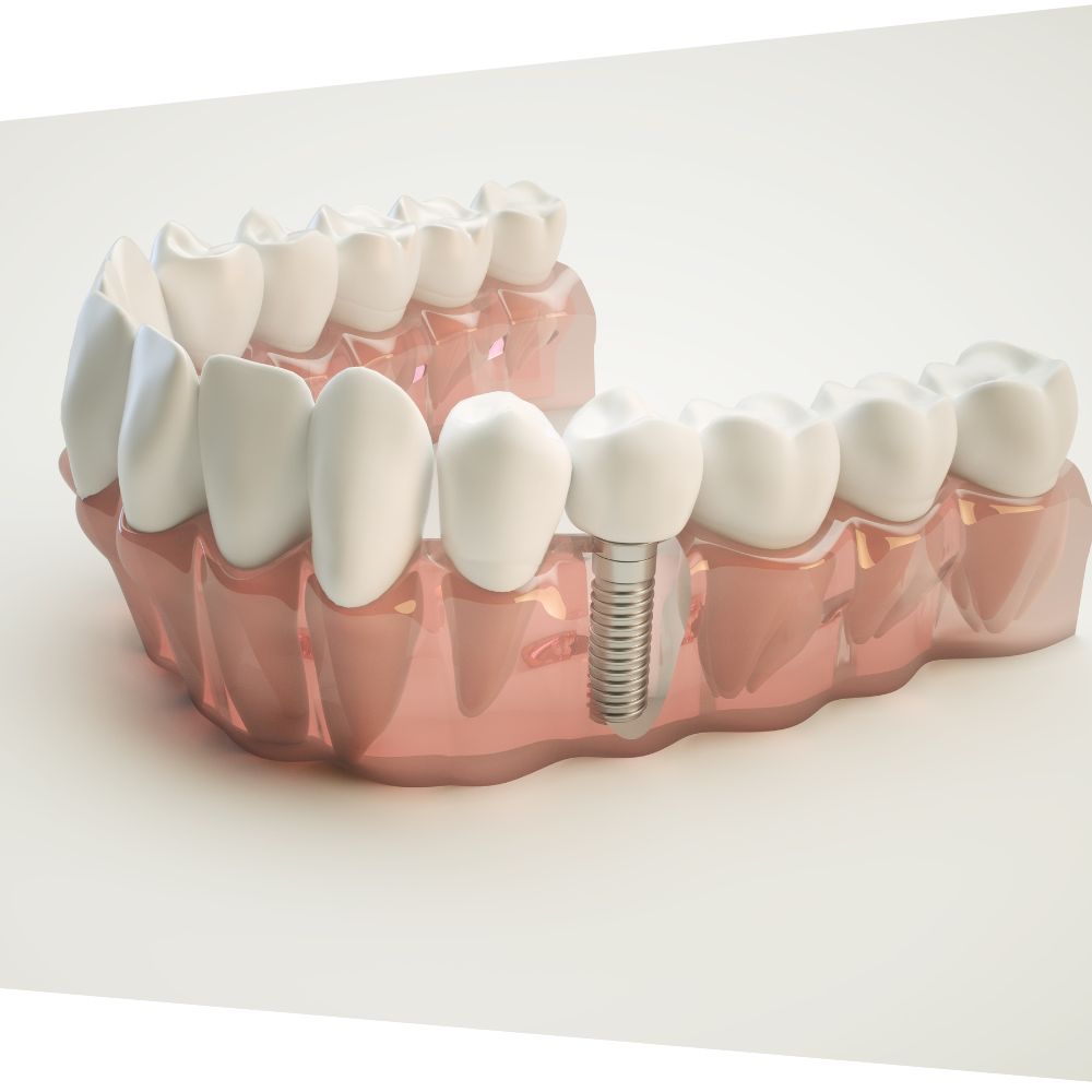 Implantologija_Dentalharmony Pale